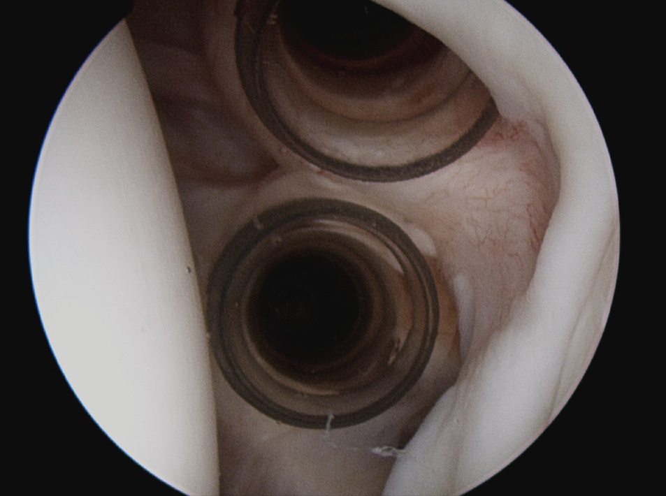 Rotator Interval 2 cannulas